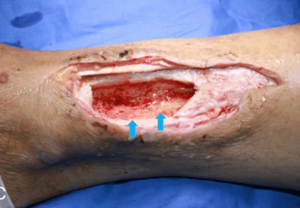 Wound regeneration